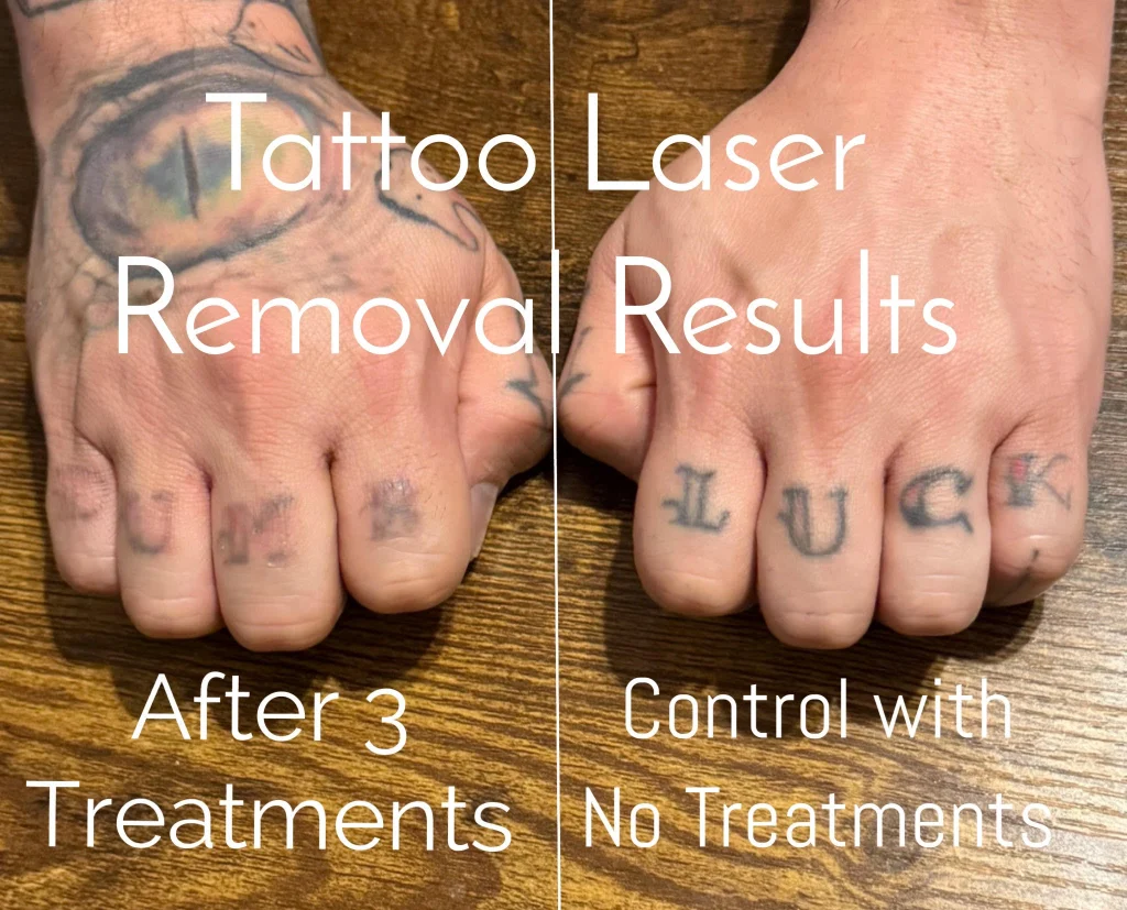 Side-by-side comparison showing a hand tattoo after 3 laser removal treatments next to an untreated hand tattoo.