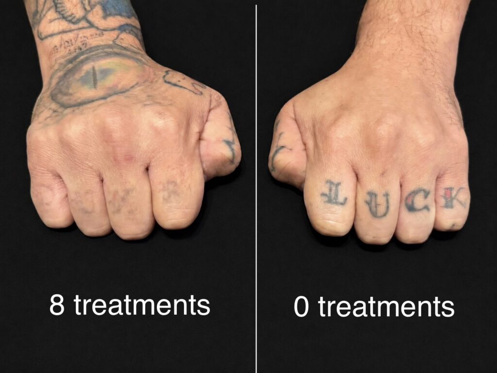 Side-by-side comparison showing a hand tattoo after 8 laser removal treatments next to an untreated hand tattoo.